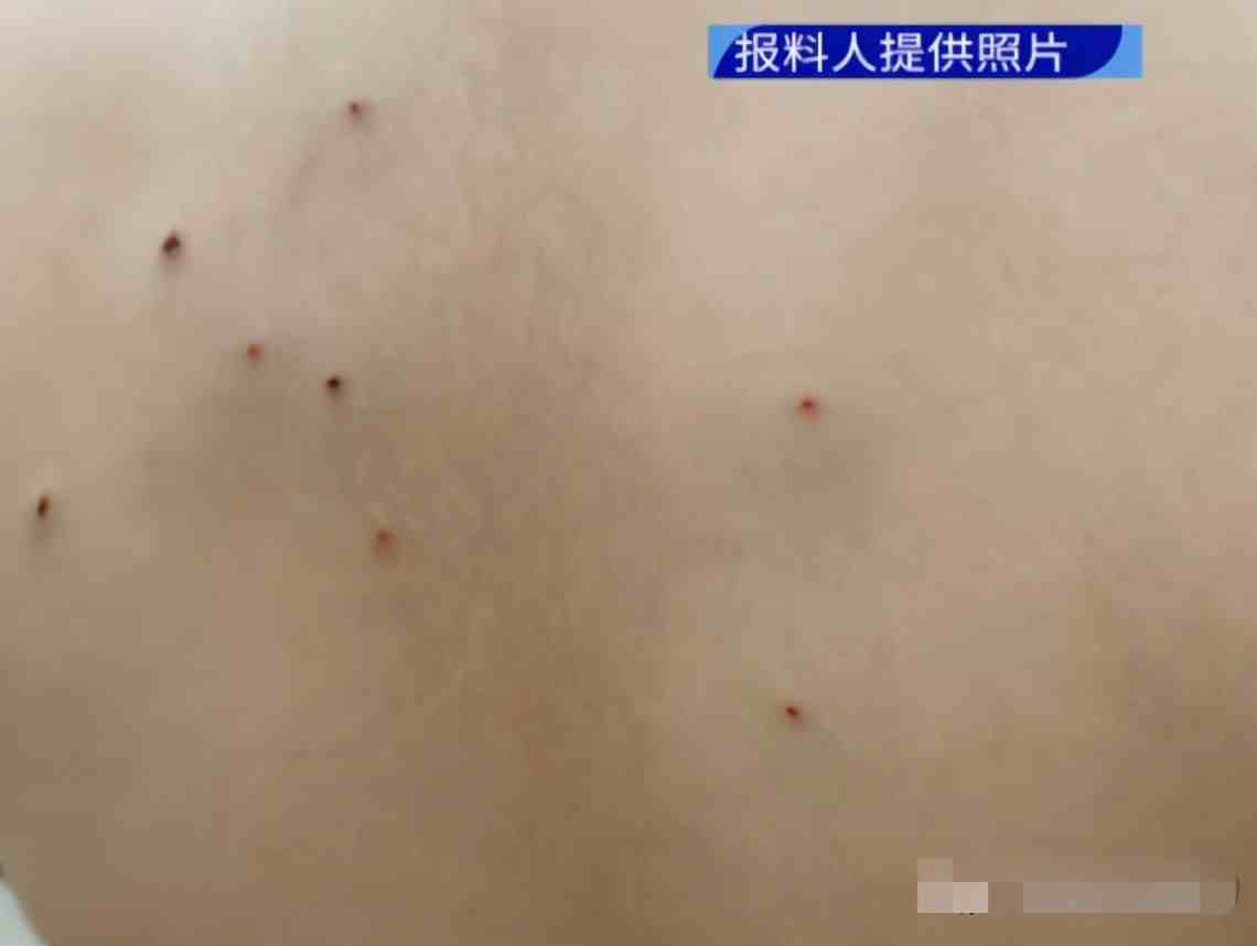 广东小学生被同学用铅笔戳出20多个黑洞，医生：铅笔屑烂碎在肉里了